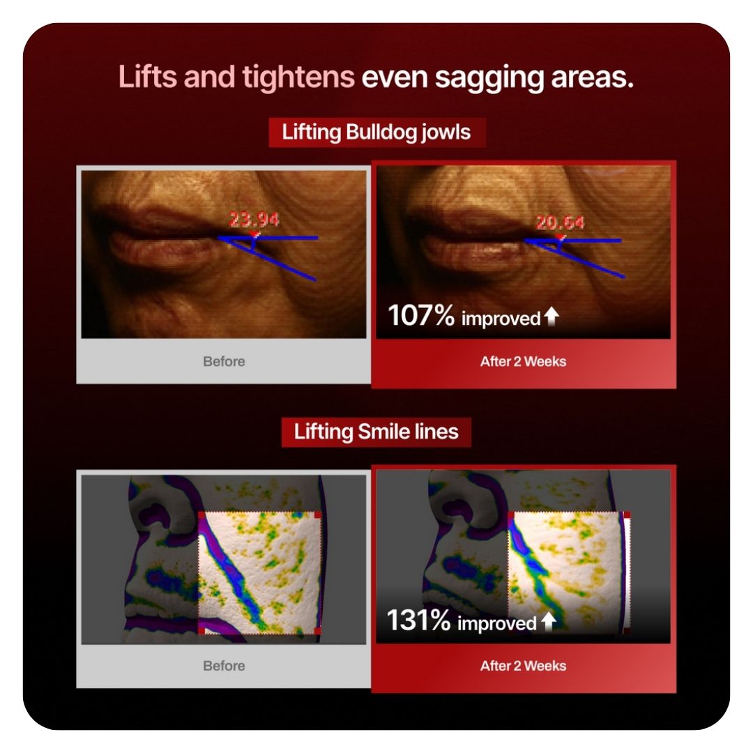 Meditherapy Wrinkle-Fit Needle Roller