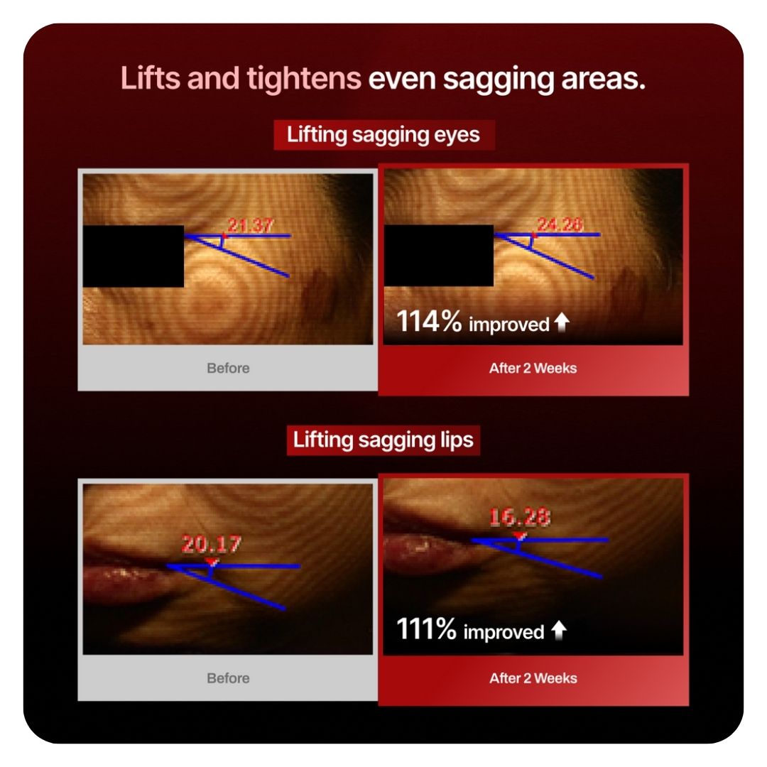 Meditherapy Wrinkle-Fit Needle Roller